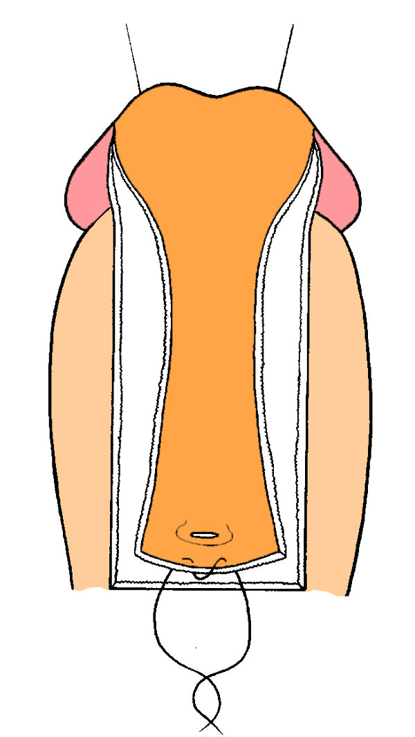 A prosztata urethral resekciója