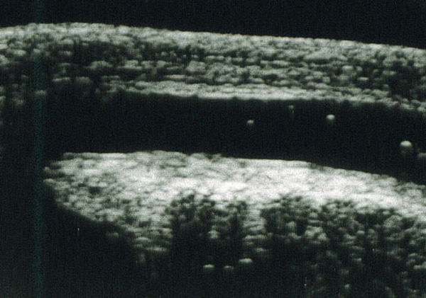 ecografia uretrala durata exacerbarii prostatitei